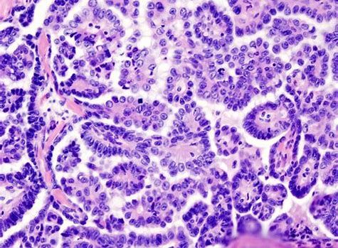 CancerRes：新研究发现帮助清除癌症干细胞的新靶标